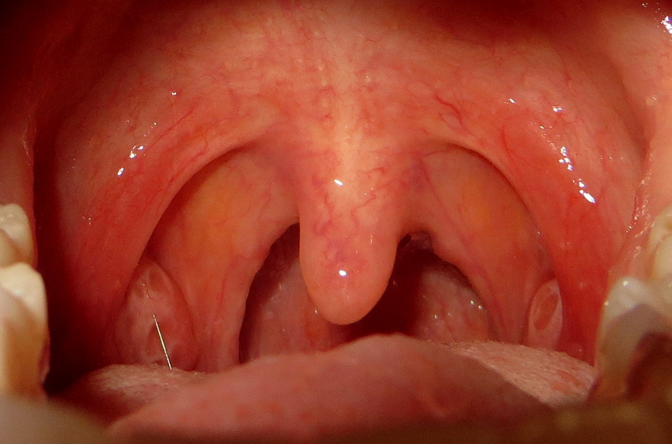 Was Könnte das sein? Halsschmerzen (Gesundheit, Schmerzen, Mandeln)