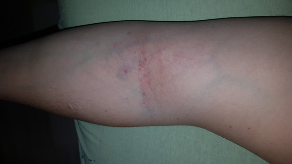 Was Konnte Das Sein Nach Blutabnahme Von Heute Gesundheit Und Medizin Blauer Fleck Was Konnte Das Sein Nach Blutabnahme Von Heute Gesundheit Und Medizin Blauer Fleck