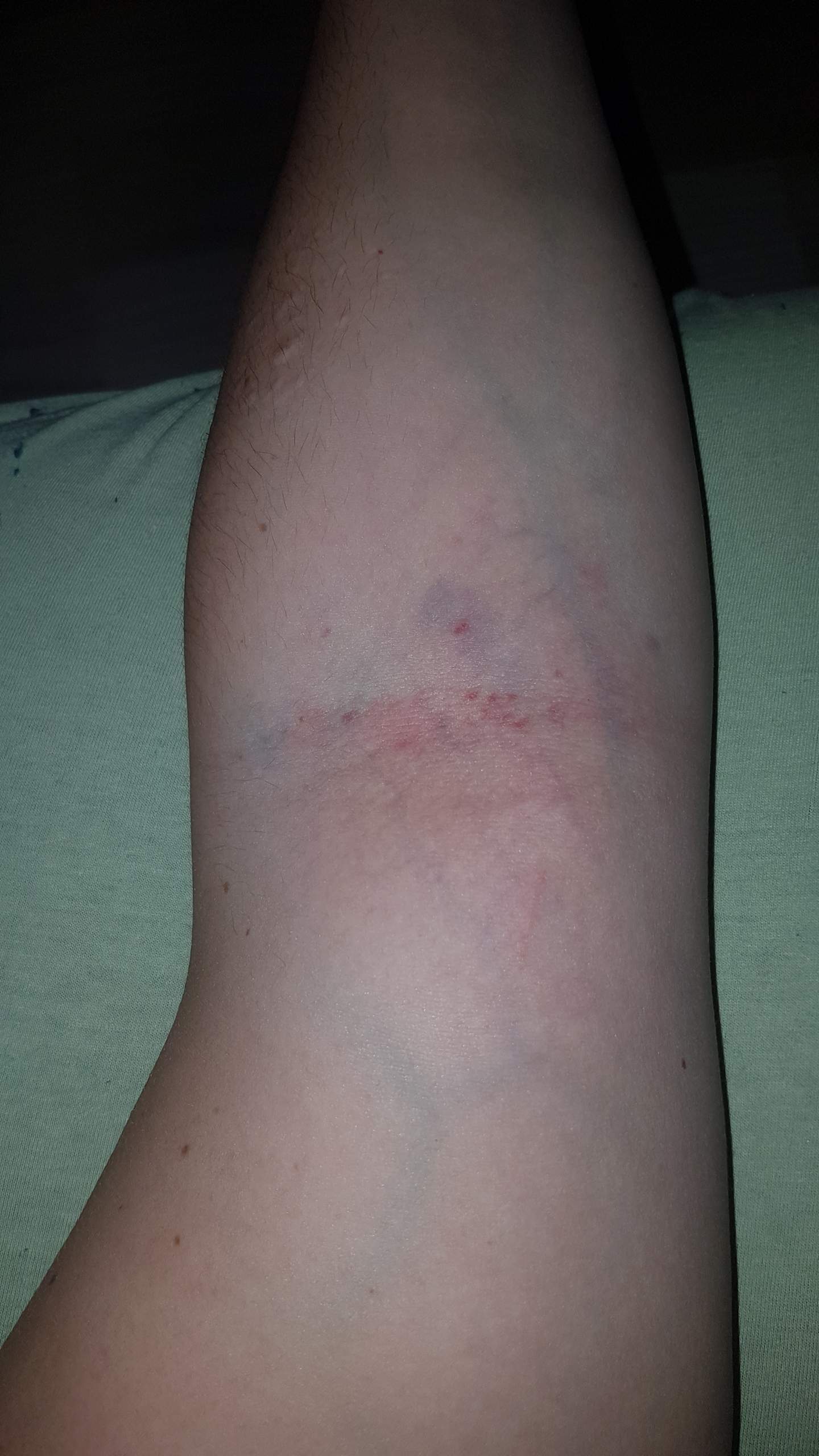 Was könnte das sein? Nach Blutabnahme von heute? (Gesundheit und Medizin, blauer Fleck)