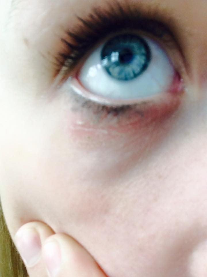 was könnte das sein? Rote, juckende und trockene Haut unter den Augen