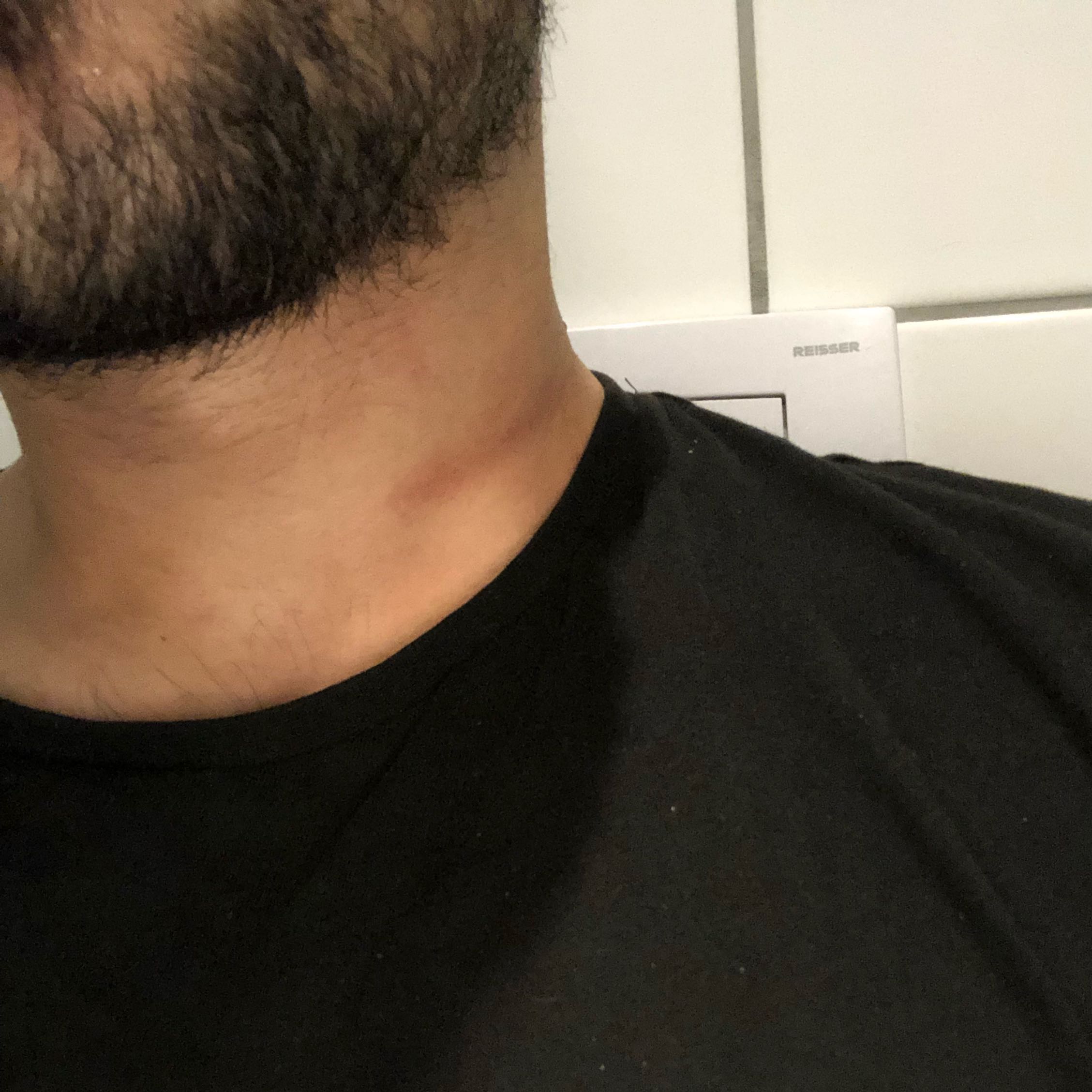 Was könnte das sein, unter der Schwellung ist ein Knoten der hart wie ...