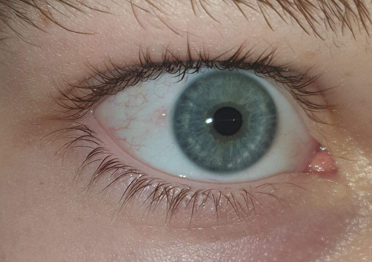 Was könnte das(siehe Bild)sein? (Gesundheit und Medizin, Arzt, Augen)