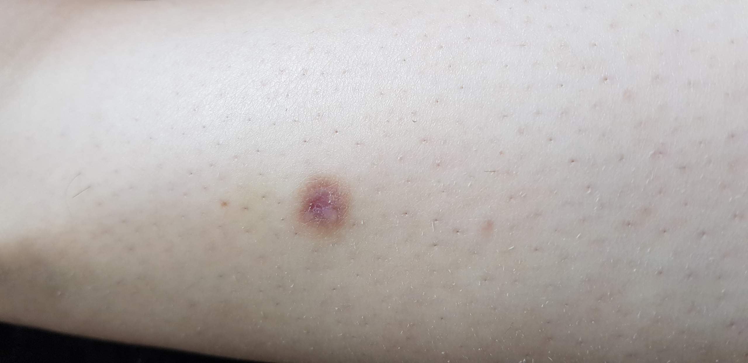 Was könnte die Stelle an meinem Bein sein? (Arzt, Hautarzt)