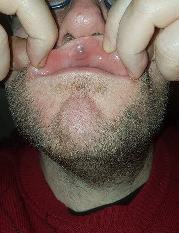 Was Konnte Dieser Knubbel An Der Lippe Sein Gesundheit Und Medizin Hautprobleme Was Konnte Dieser Knubbel An Der Lippe Sein Gesundheit Und Medizin Hautprobleme