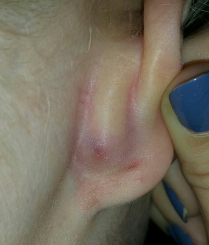 Was Konnte Dieser Knubbel Hinter Dem Ohr Sein Gesundheit Schmerzen Was Konnte Dieser Knubbel Hinter Dem Ohr Sein Gesundheit Schmerzen