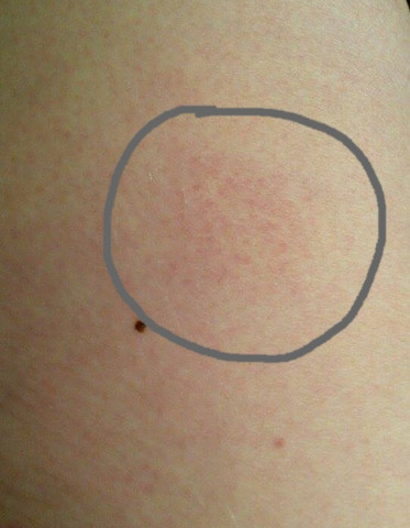 Was Konnte Dieser Rote Fleck Sein Bild Haut Hautkrebs Was Konnte Dieser Rote Fleck Sein Bild Haut Hautkrebs