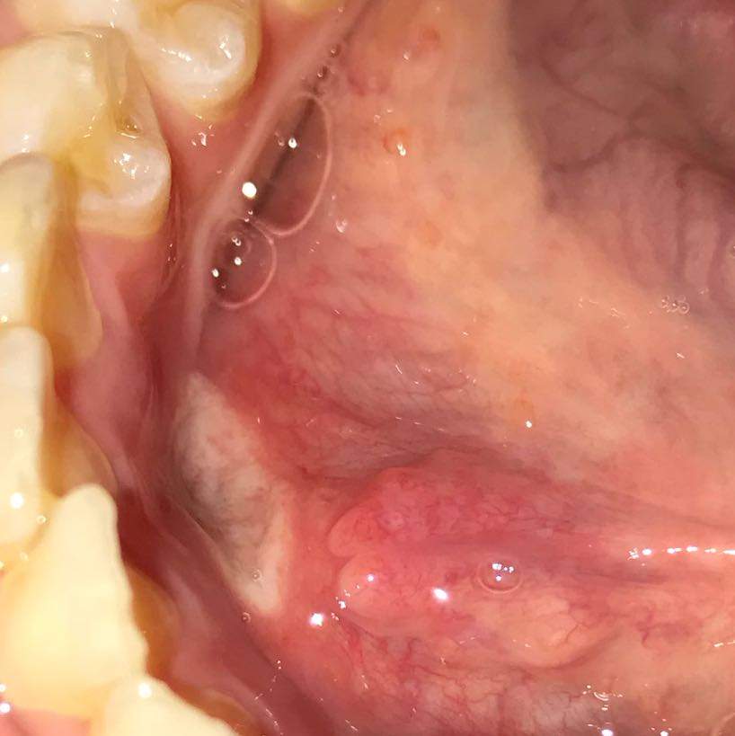 Was könnte dieses weiße Ding an meinen Zahnfleisch sein? (Gesundheit und Medizin, entzündet, aphten)