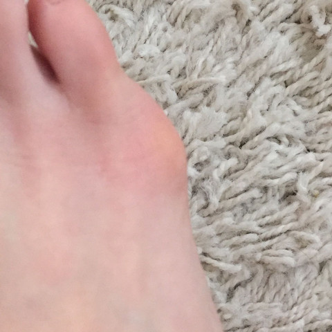 Was Konnte Es Sein Uberbein Gesundheit Und Medizin Schmerzen Fusse Was Konnte Es Sein Uberbein Gesundheit Und Medizin Schmerzen Fusse