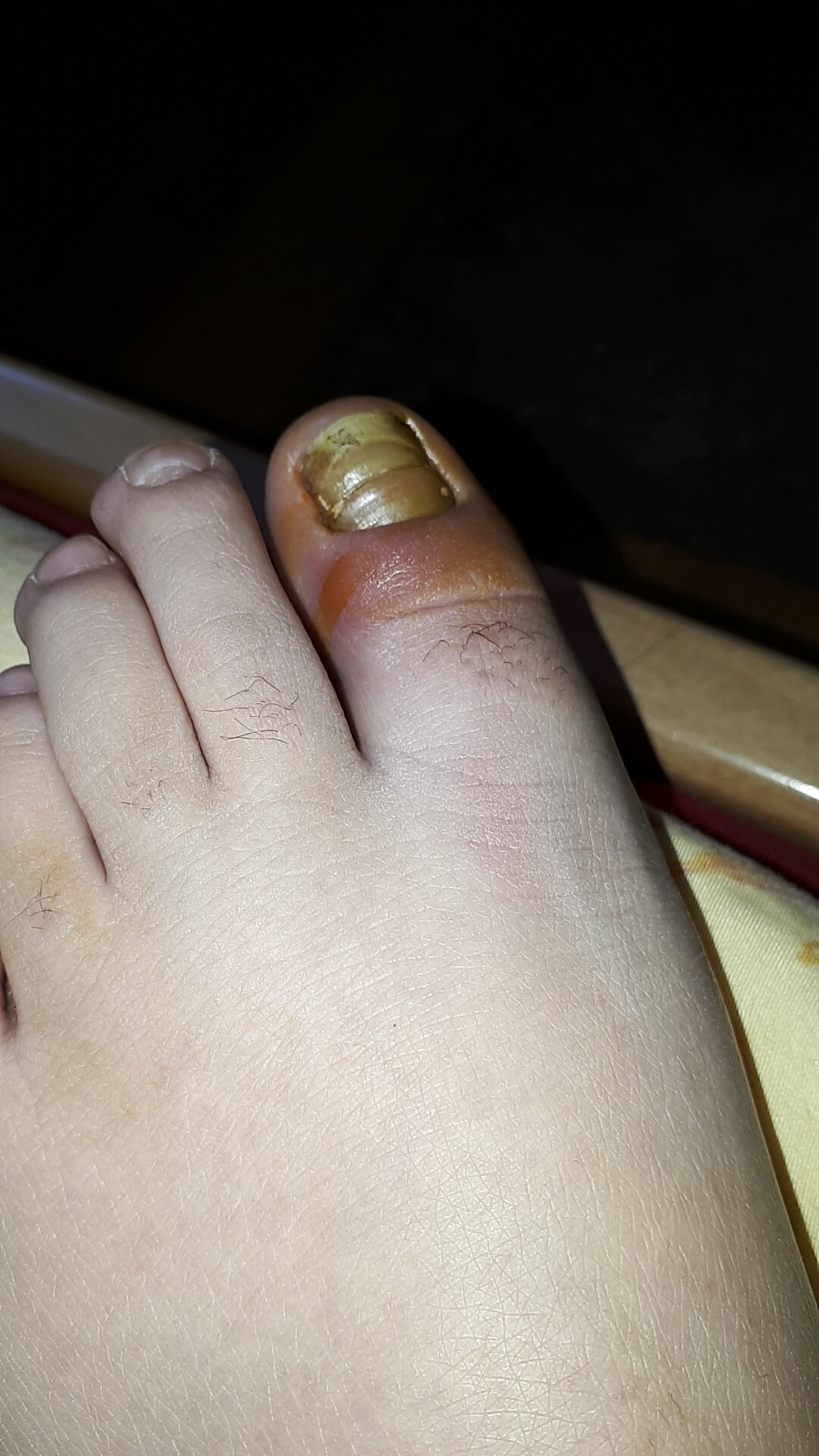 Geschwollener großer Zeh