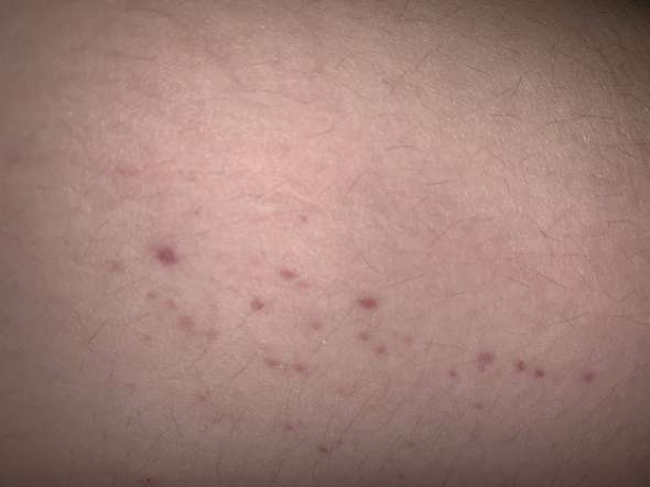 Petechien nach kratzen