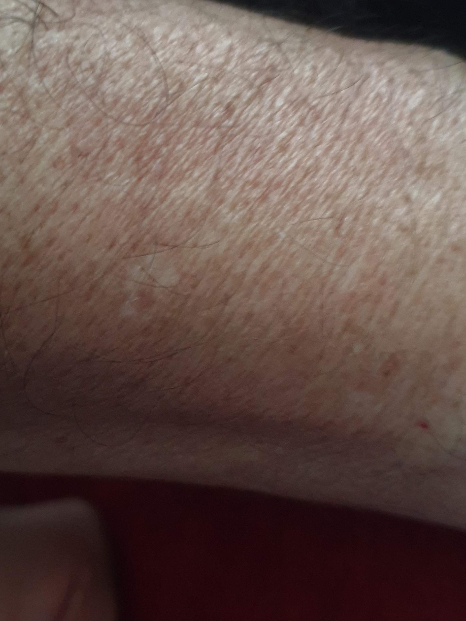 Was könnten das für weiße Flecken am Arm sein? (Gesundheit und Medizin