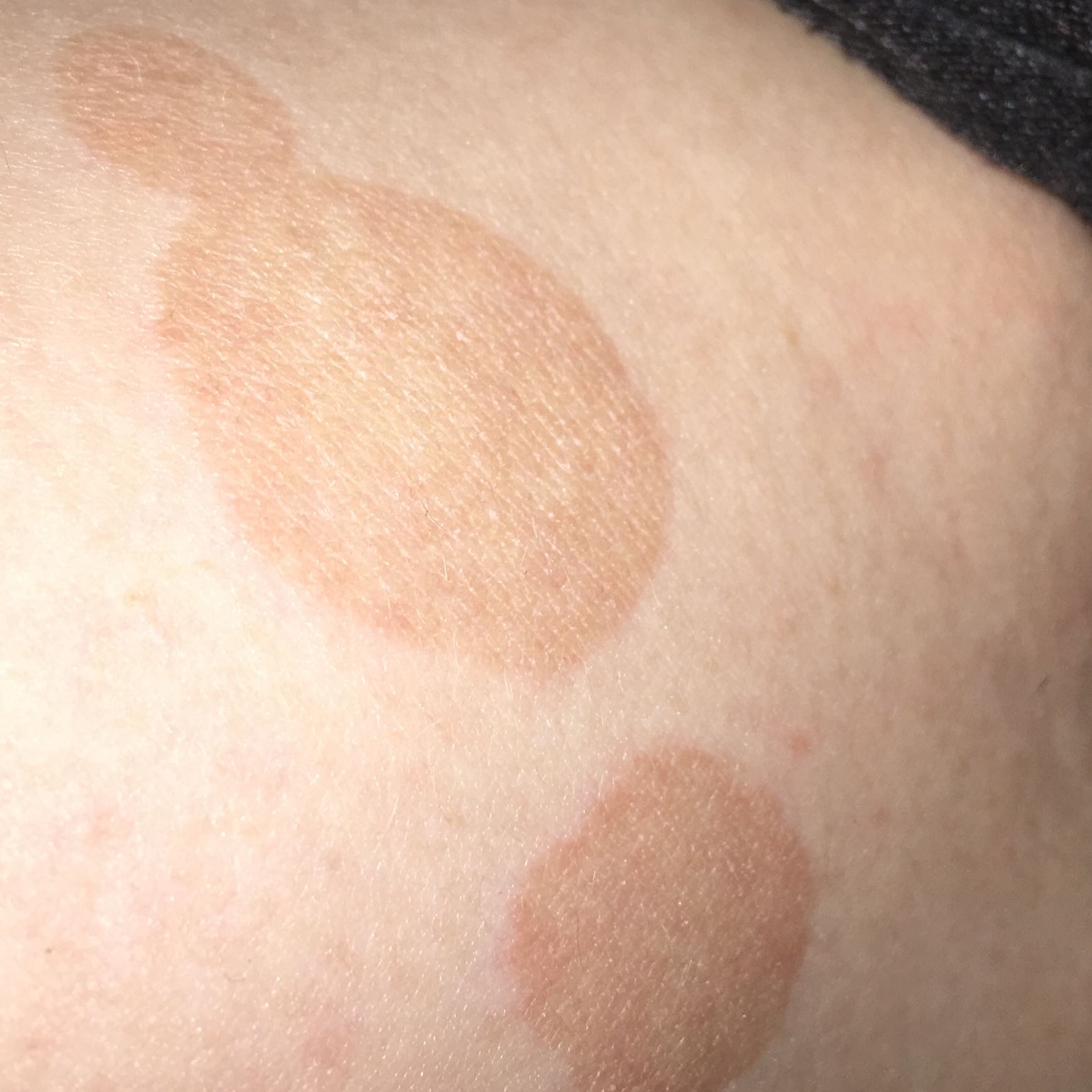 Was könnten dass für Flecken sein? (Haut, was ist das) Was könnten dass für Flecken sein? (Haut, was ist das)