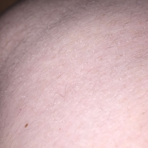 Was Konnten Denn Die Blaschen Sein Hilfe Gesundheit Und Medizin Korper Haut Was Konnten Denn Die Blaschen Sein Hilfe Gesundheit Und Medizin Korper Haut