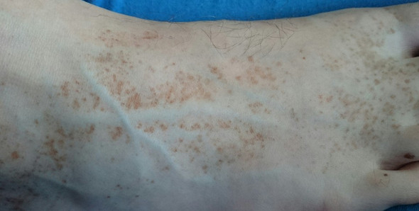 Was Konnten Diese Braunen Flecken Auf Den Fussen Sein Gesundheit Korper Haut Was Konnten Diese Braunen Flecken Auf Den Fussen Sein Gesundheit Korper Haut