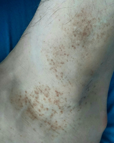Was Konnten Diese Braunen Flecken Auf Den Fussen Sein Gesundheit Korper Haut Was Konnten Diese Braunen Flecken Auf Den Fussen Sein Gesundheit Korper Haut