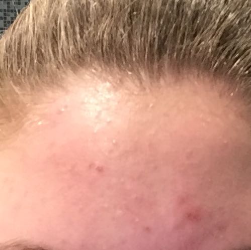 pickel am stirn pickel am stirn