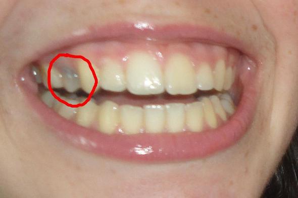 Was Macht Der Zahnarzt Bei Einem Schwarzen Zahn Zahne