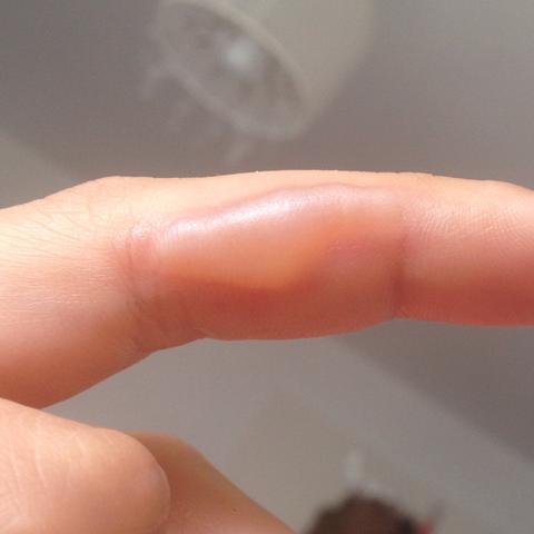 Was Macht Man Bei Einer Brandblase Finger Blase Verbrennung Was Macht Man Bei Einer Brandblase Finger Blase Verbrennung