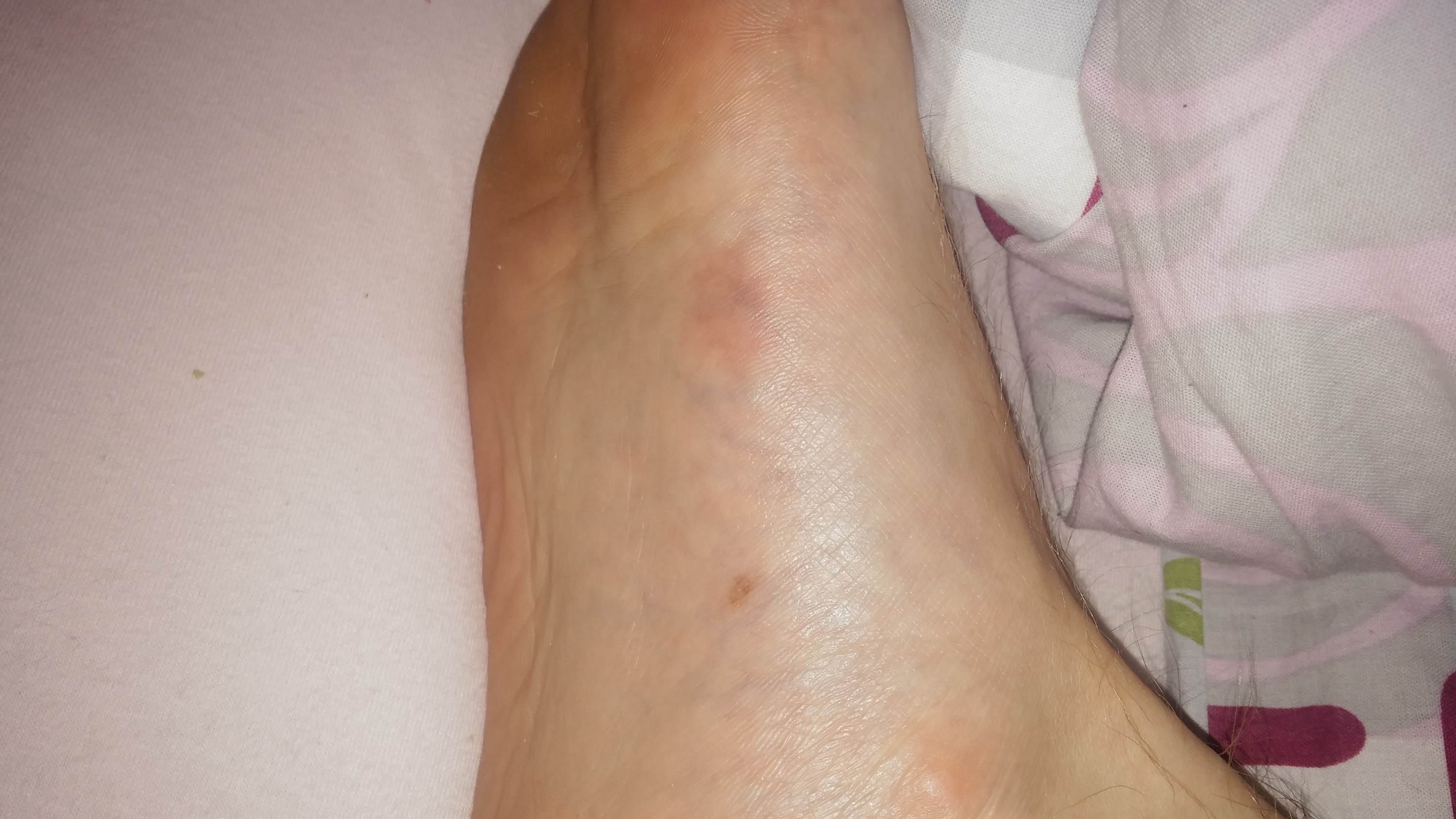 Was Meint Ihr Ist Das Eine Thrombose Es Tut Ein Bisschen Weh Wenn Ich Auftrette Und Manchmal Habe Ich So Ein Brennendes Gefuhl An Der Stelle Was Meint Ihr Ist Das Eine Thrombose Es Tut Ein Bisschen Weh Wenn Ich Auftrette Und Manchmal Habe Ich So Ein Brennendes Gefuhl An Der Stelle