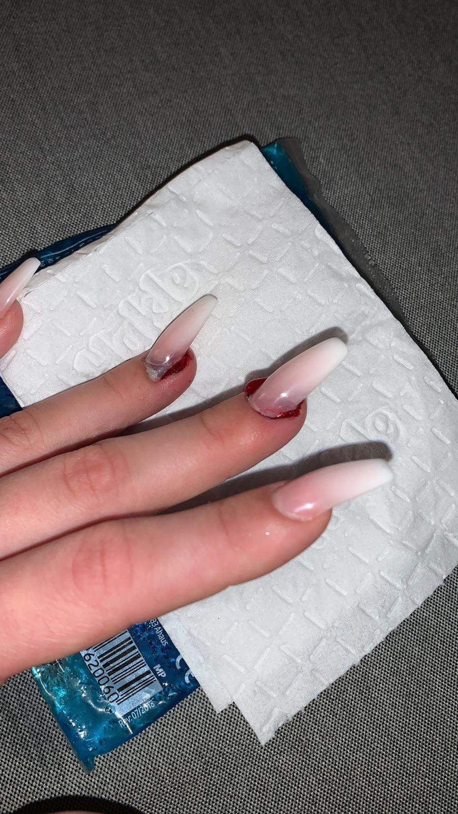 was mit abgerissenem fingernagel tun fingernagel