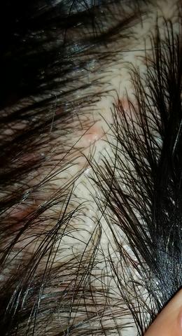 Was Sind Das Fur Rote Punkte Auf Meiner Kopfhaut Entzundung Akne Haarausfall