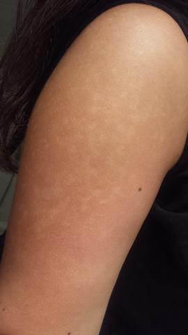 Was Sind Das Flecken Auf Meiner Haut Die Nach Dem Sonnen Entstanden Sind Gesundheit Beauty Sonnenbrand Was Sind Das Flecken Auf Meiner Haut Die Nach Dem Sonnen Entstanden Sind Gesundheit Beauty Sonnenbrand