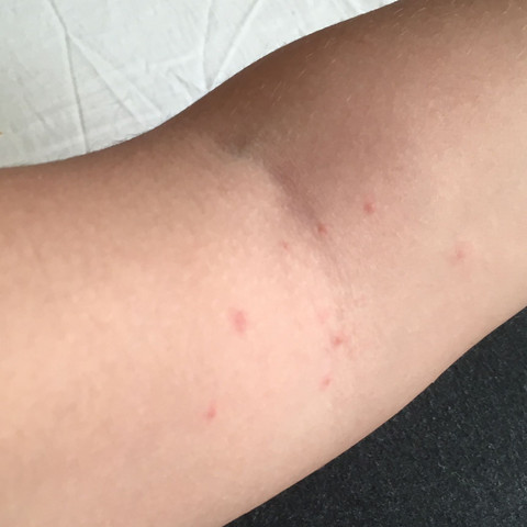 Was Sind Das Fur Rote Punkte An Meiner Haut Gesundheit Und Medizin Komisch Jucken Was Sind Das Fur Rote Punkte An Meiner Haut Gesundheit Und Medizin Komisch Jucken
