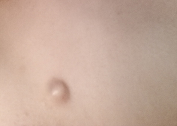 Was Sind Das Fur Bollen Gesundheit Pickel Akne Was Sind Das Fur Bollen Gesundheit Pickel Akne