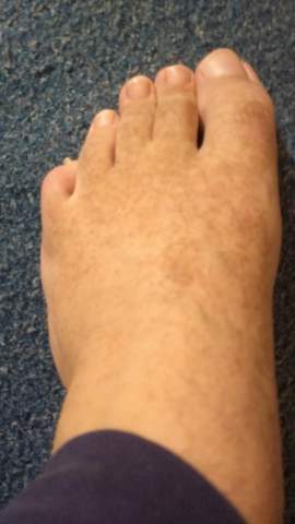 Was Sind Das Fur Braune Punkte Am Bein Haut