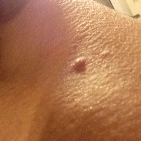 Was Sind Das Fur Eitrige Pickel Gesundheit Haut