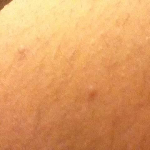 Was Sind Das Fur Eitrige Pickel Gesundheit Haut