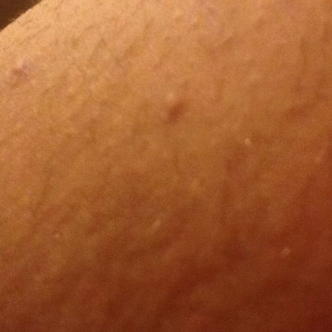 Was Sind Das Fur Eitrige Pickel Gesundheit Haut