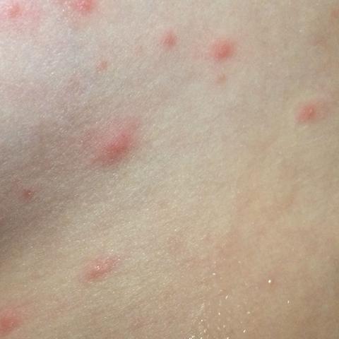 Ausschlag Auf Der Eichel Bilder