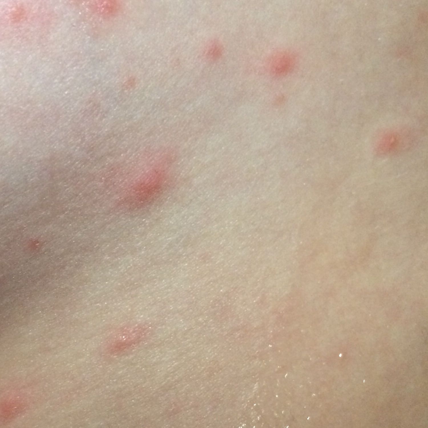 Was sind das für eklige Pickel?😖😖 (Gesundheit, Krankheit, Haut) Was sind das für eklige Pickel?😖😖 (Gesundheit, Krankheit, Haut)