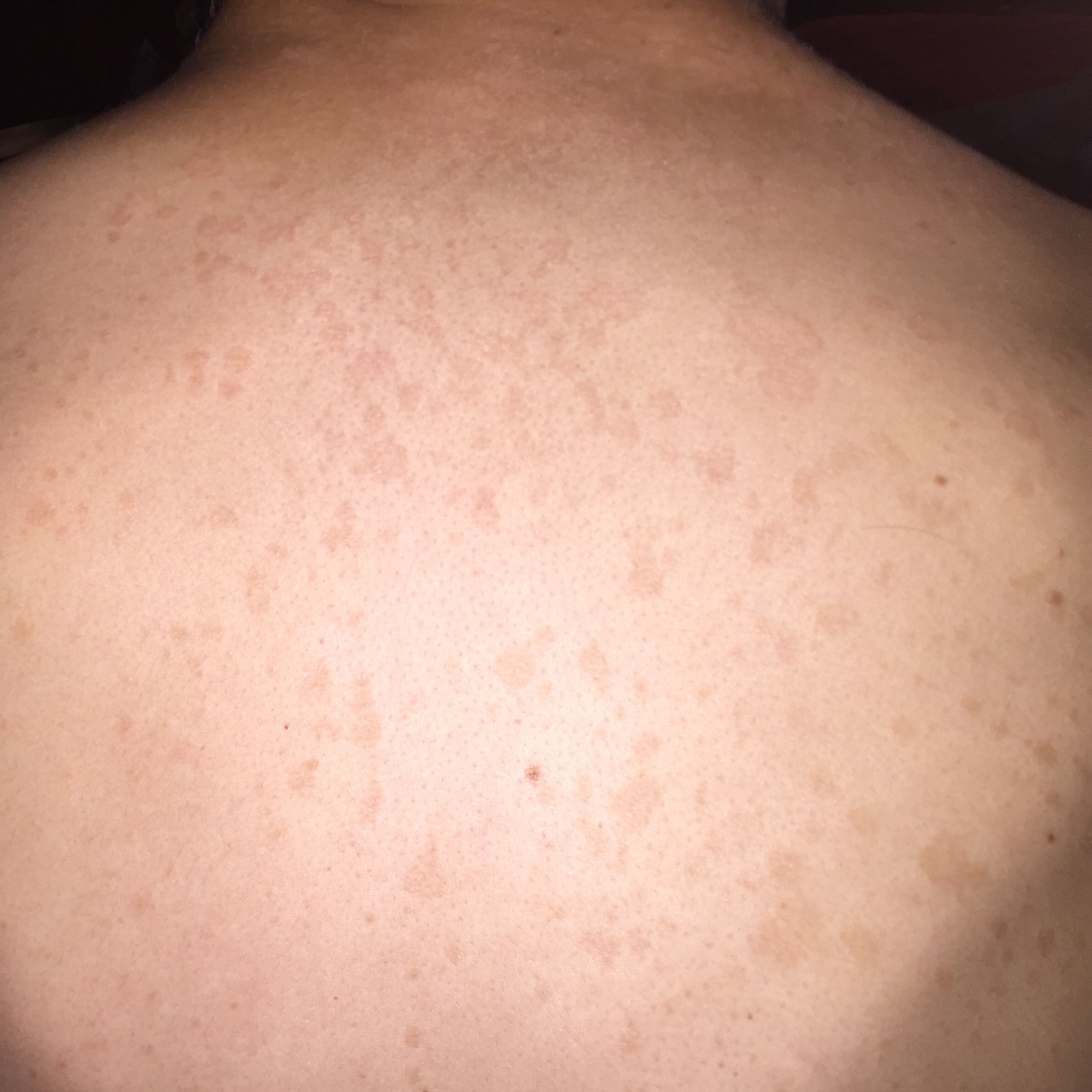 Was sind das für Flecken am Rücken (Bild)? (Körper, Haut)