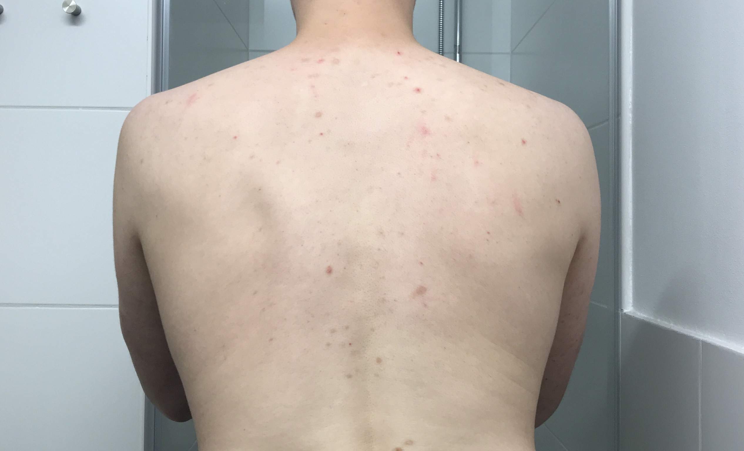 Was sind das für Flecken am Rücken hier? (Medizin, Haut, Dermatologie)