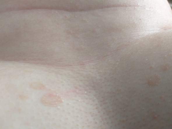 Was Sind Das Fur Flecken Auf Der Unteren Brust Gesundheit Haut Flechten Was Sind Das Fur Flecken Auf Der Unteren Brust Gesundheit Haut Flechten