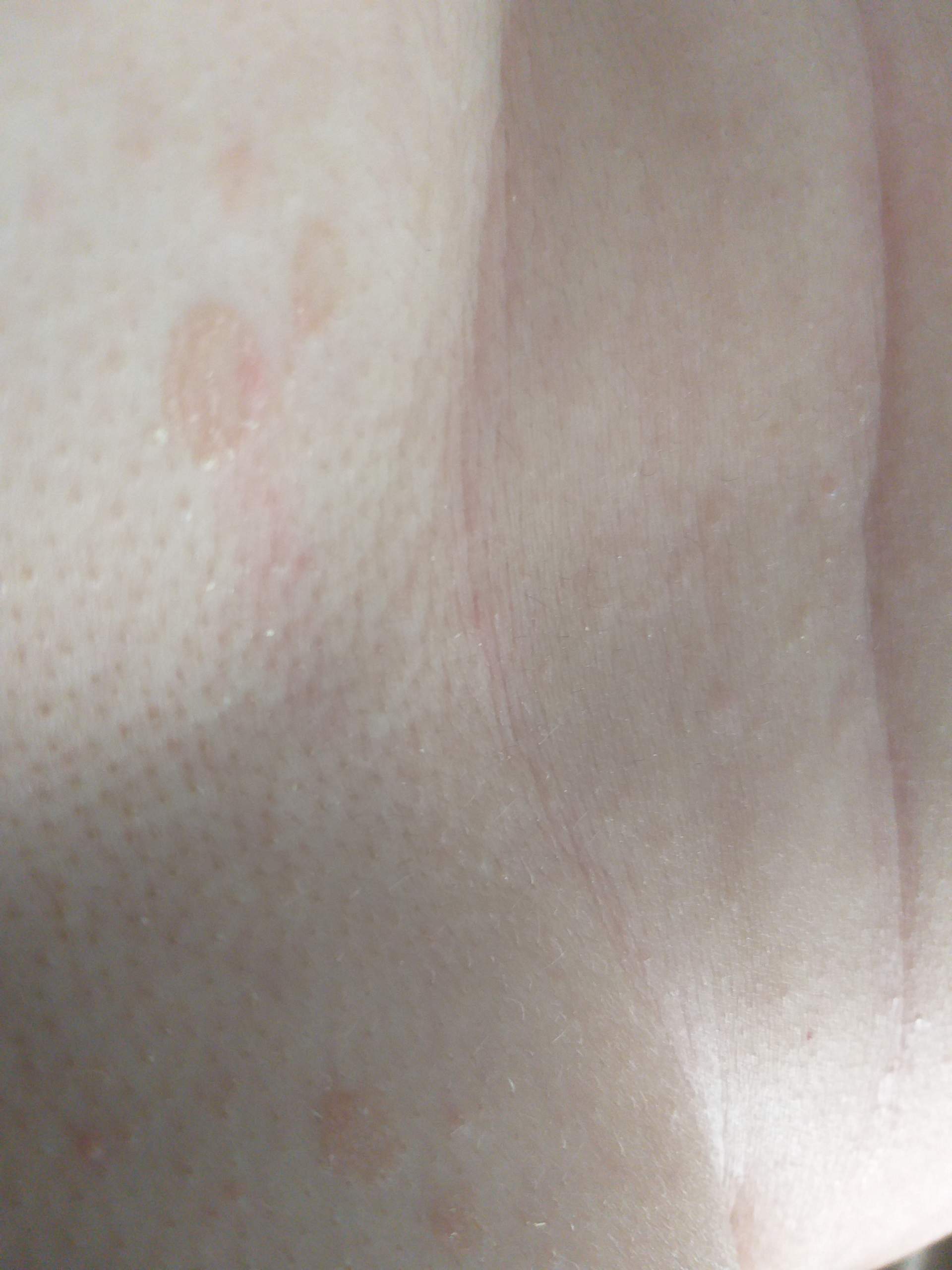 Was Sind Das Fur Flecken Auf Der Unteren Brust Gesundheit Haut Flechten Was Sind Das Fur Flecken Auf Der Unteren Brust Gesundheit Haut Flechten