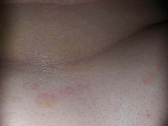 Was sind das für Flecken auf der unteren Brust? (Gesundheit, Haut Was sind das für Flecken auf der unteren Brust? (Gesundheit, Haut