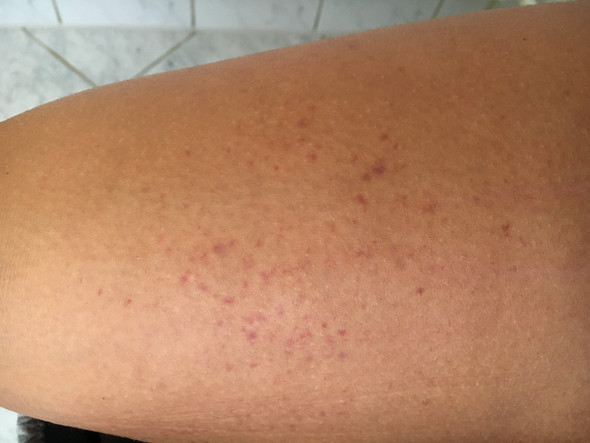 Was Sind Das Fur Flecken Auf Mein Bein Beine