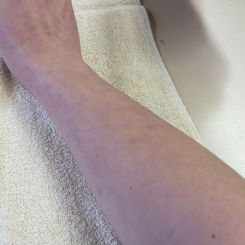 Rechter Arm - (Flecken, Arm)