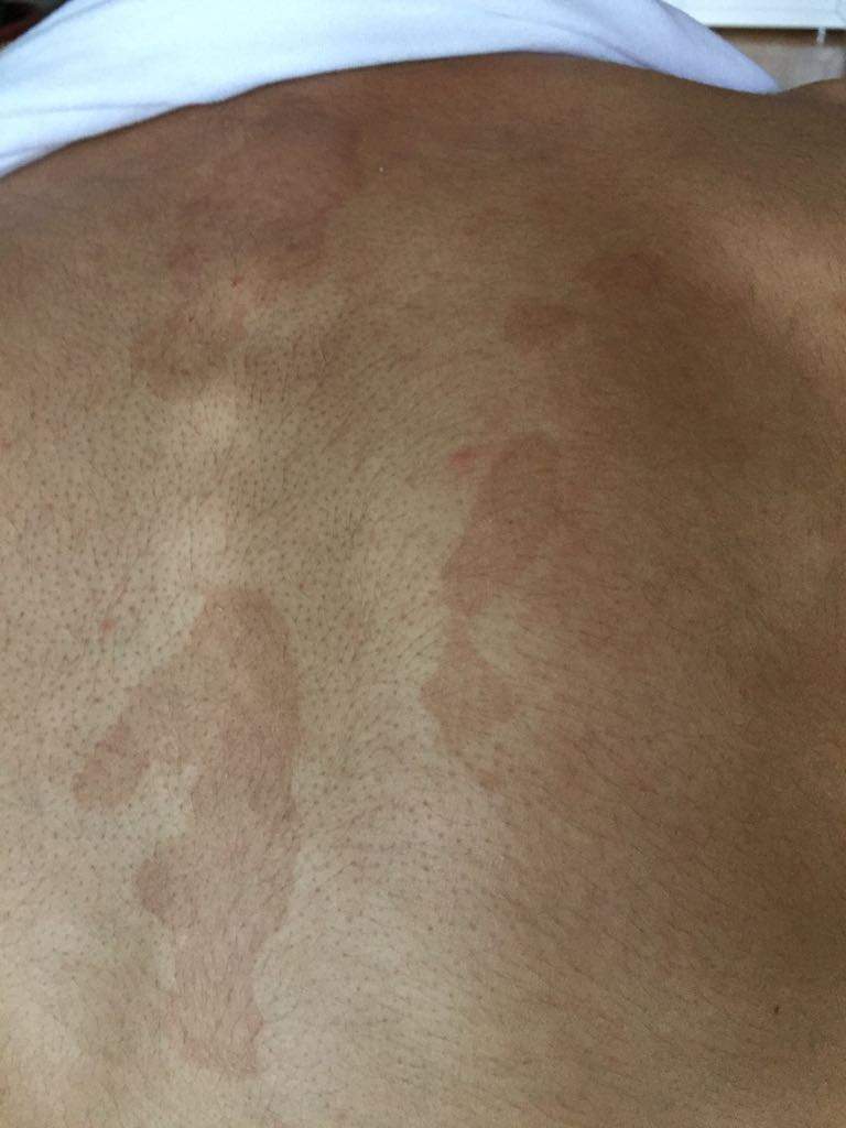 Was sind das für Flecken auf meinem Rücken? (Arzt, Haut)