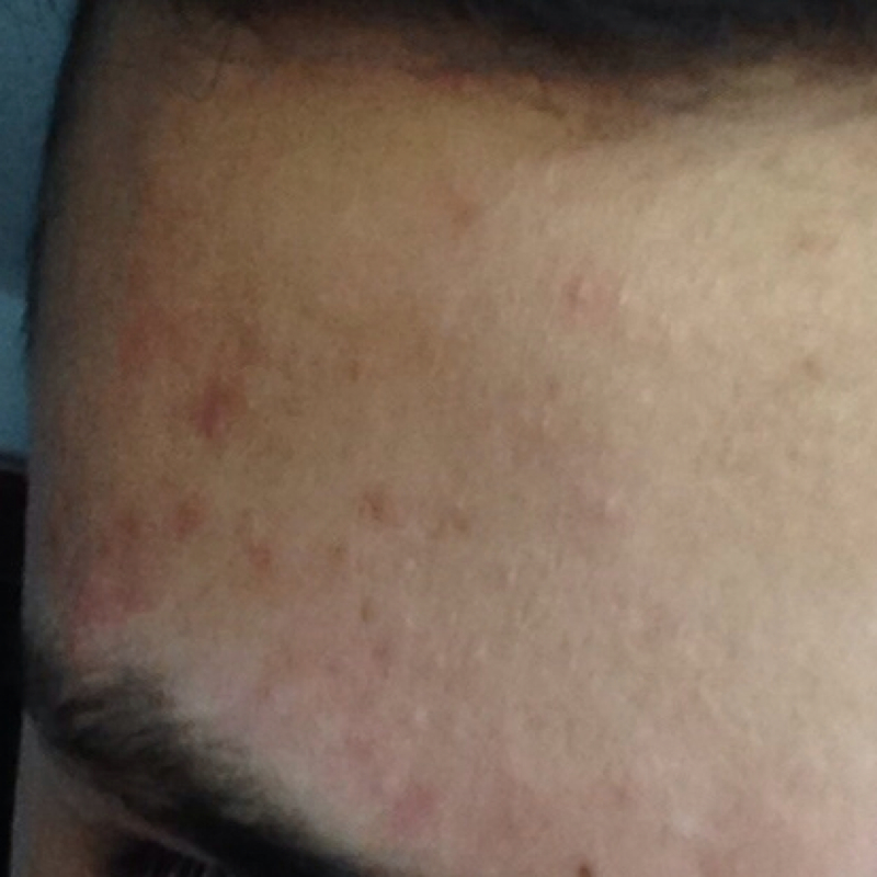 Was sind das für Flecken auf meiner Stirn (mit Bild) Re ...