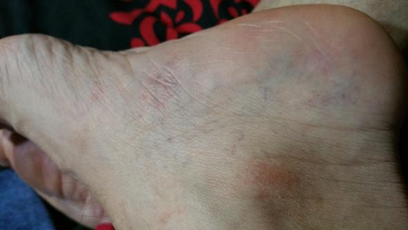 Was Sind Das Fur Flecken Hiv Ausschlag Aids