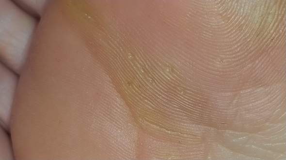 Was sind das für harte Stellen am Fußballen? (Gesundheit und Medizin ...