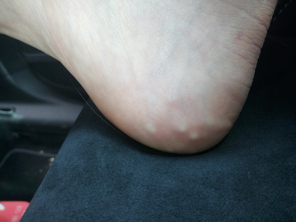 Was Sind Das Fur Hugelchen Haut Schmerzlos Huegel Was Sind Das Fur Hugelchen Haut Schmerzlos Huegel