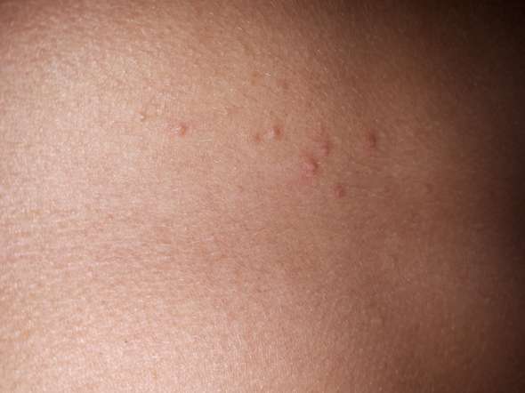 Was sind das für (juckende) Pickel? ? (Haut) pickel am oberen rücken