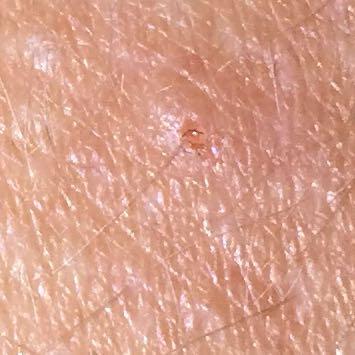 Was Sind Das Fur Juckende Pickel Auf Meinem Rucken Ausschlag Jucken