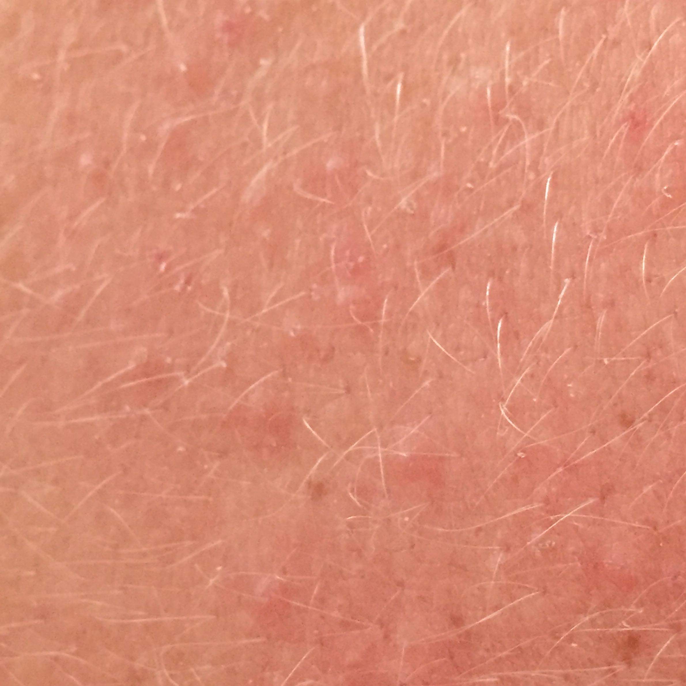 Was sind das für Juckende Pickel auf meinem Rücken? (Ausschlag, jucken)