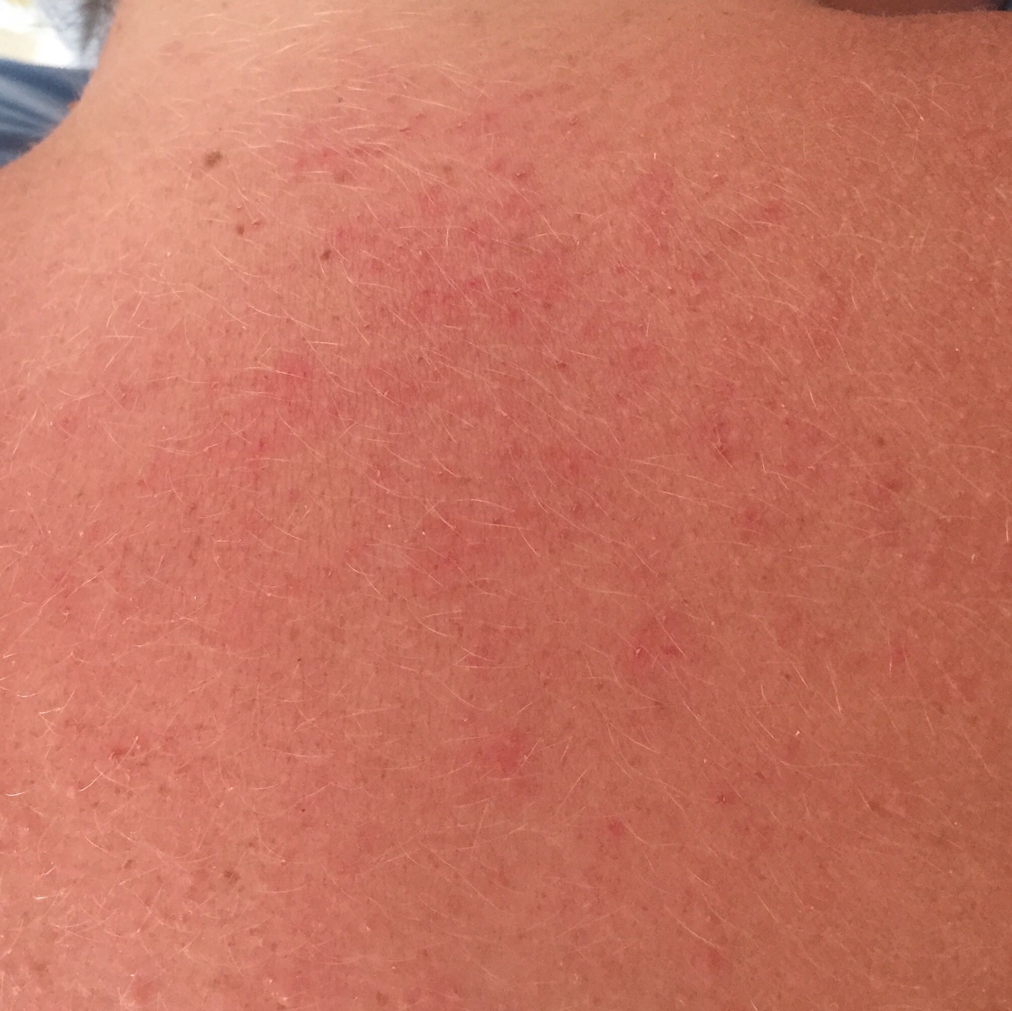 pickel jucken wange pickel jucken wange